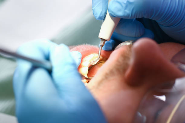 Best Emergency Dental Extractions in Johnstonville, CA
